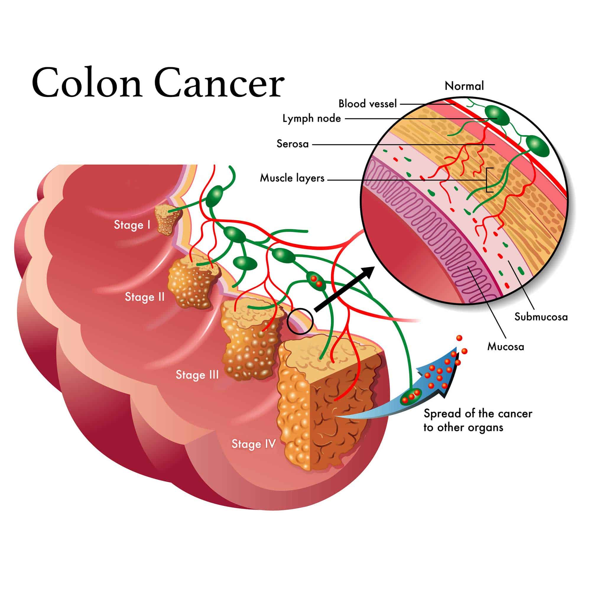 Coloncancer