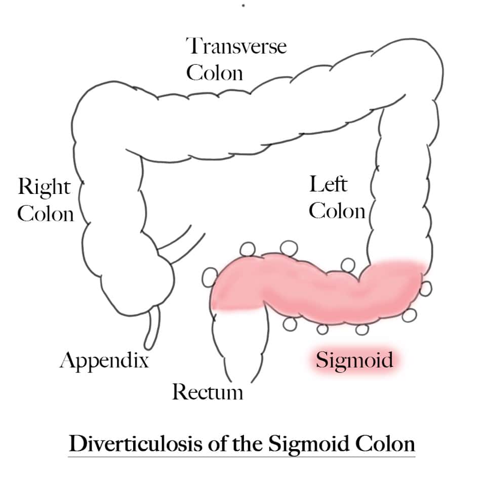 Diverticulosis Pic Labels