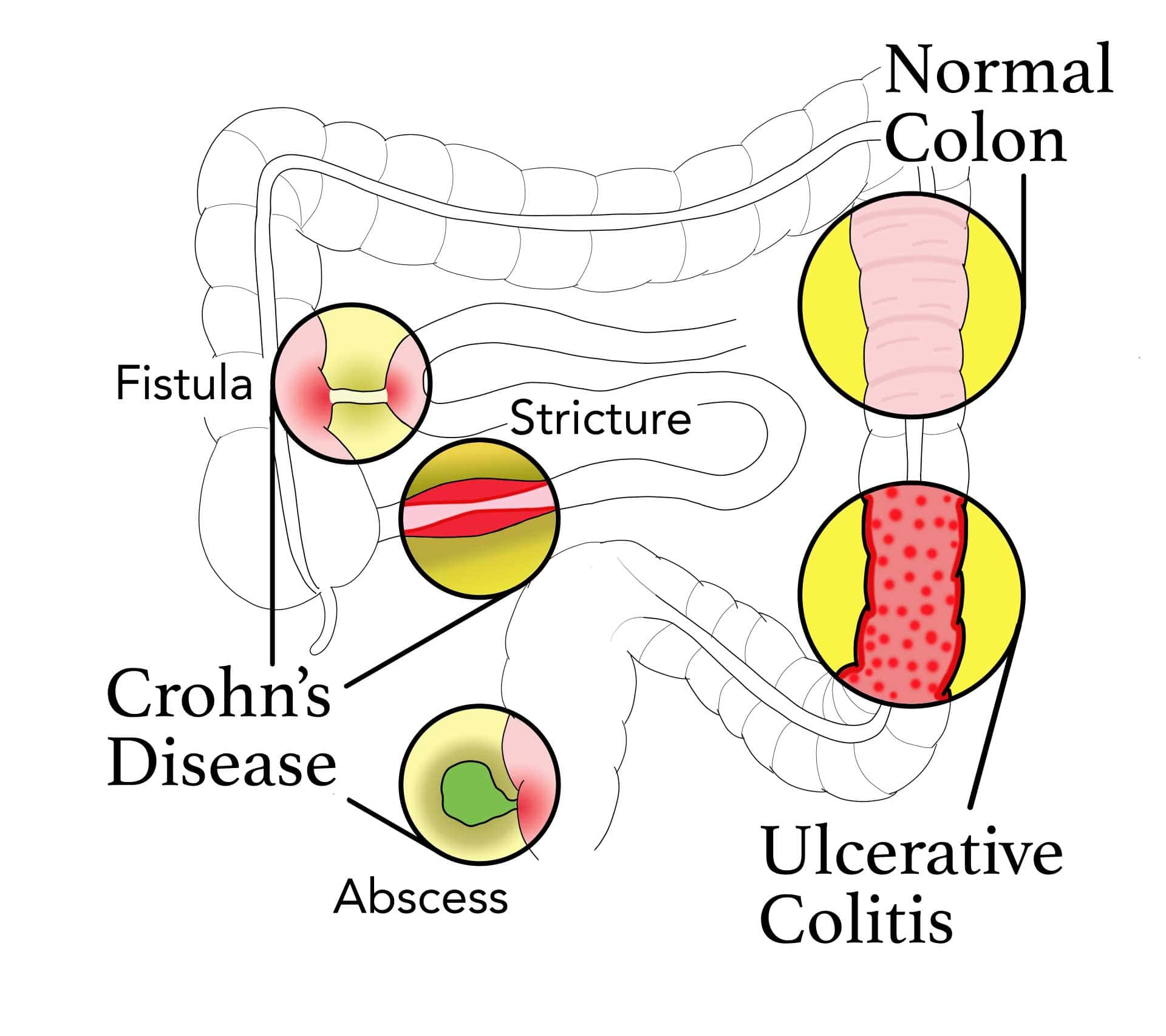 Inflammatory Bowel Disease