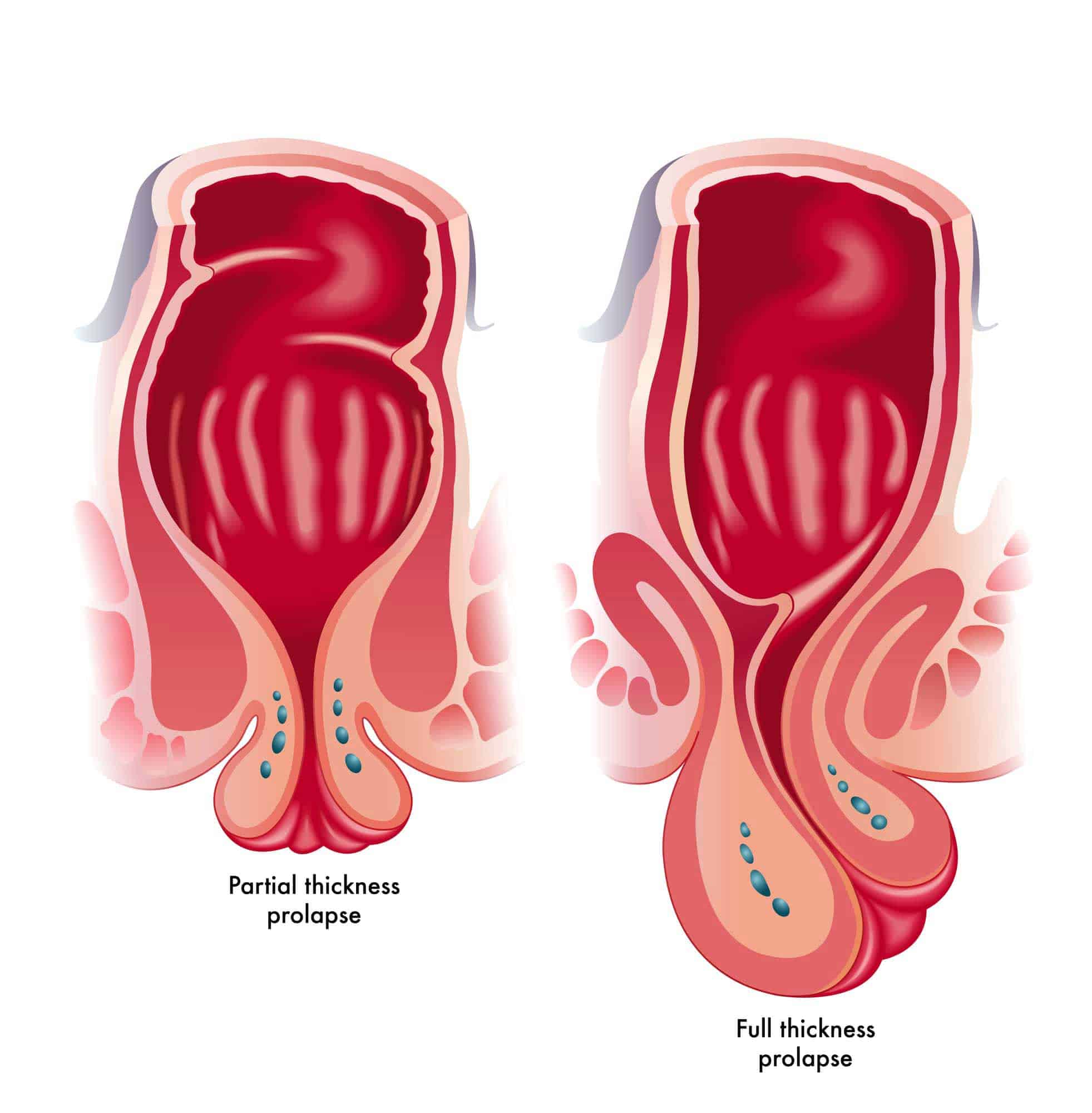 Rectal Prolapse Edit